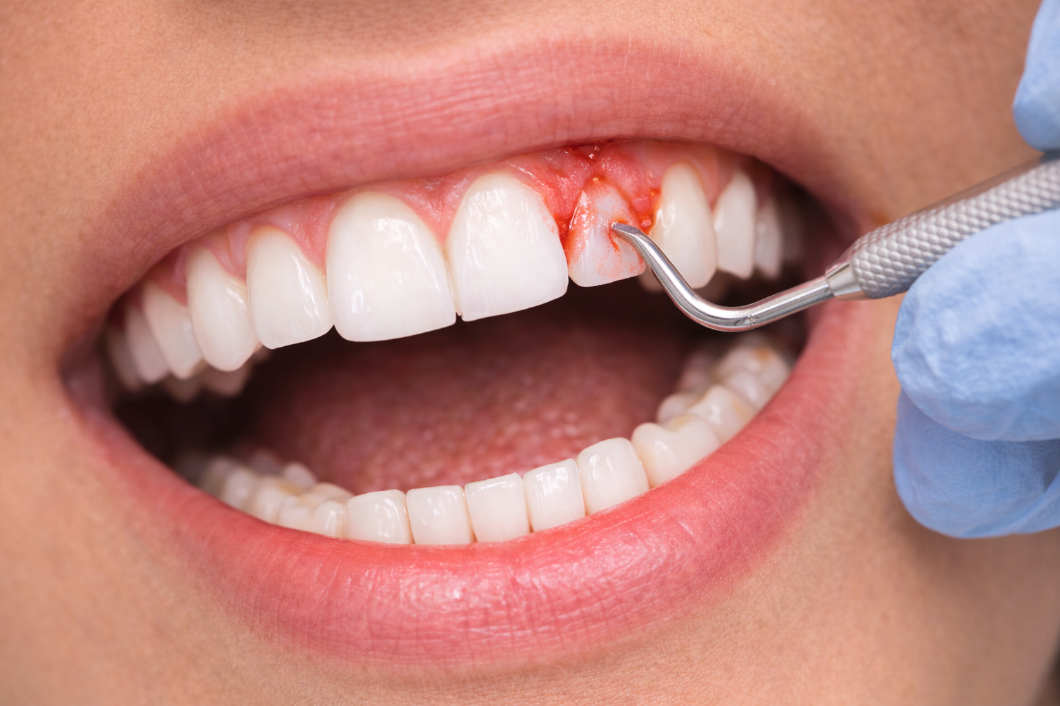 Gum treatment and periodontal care