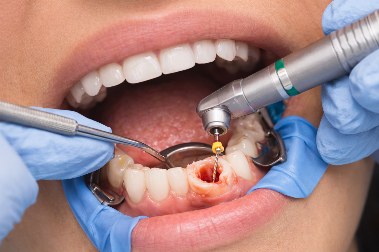 Root canal treatment care
