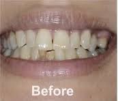 After teeth whitening
